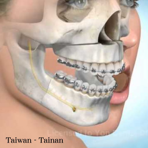 台南正顎手術權威醫師推薦