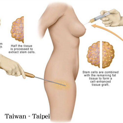 台北自體脂肪移植手術權威醫師推薦