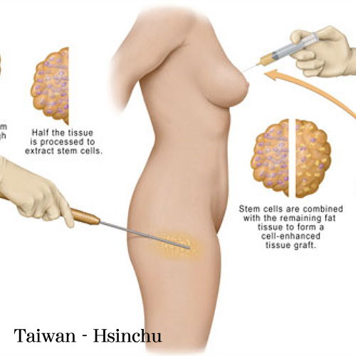 新竹自體脂肪移植手術權威醫師推薦