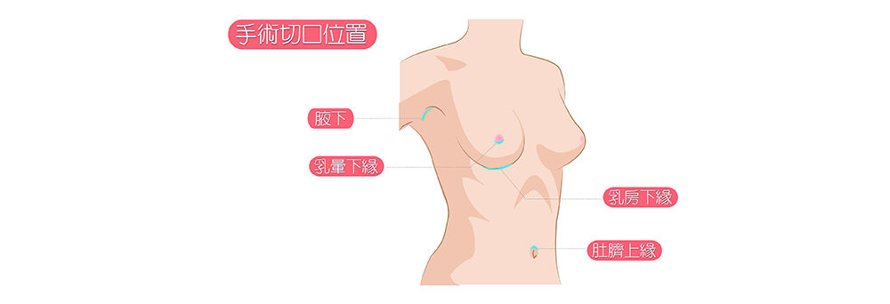 隆乳手術的切口位置