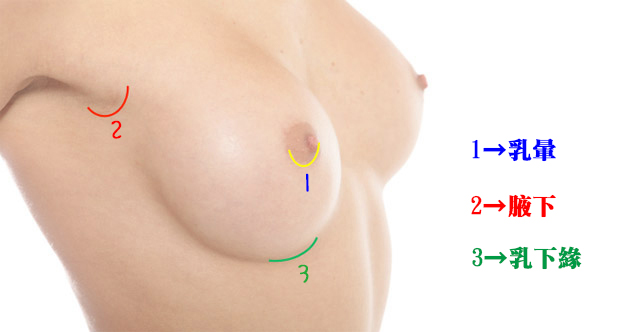隆乳方式常見切口位置示意圖